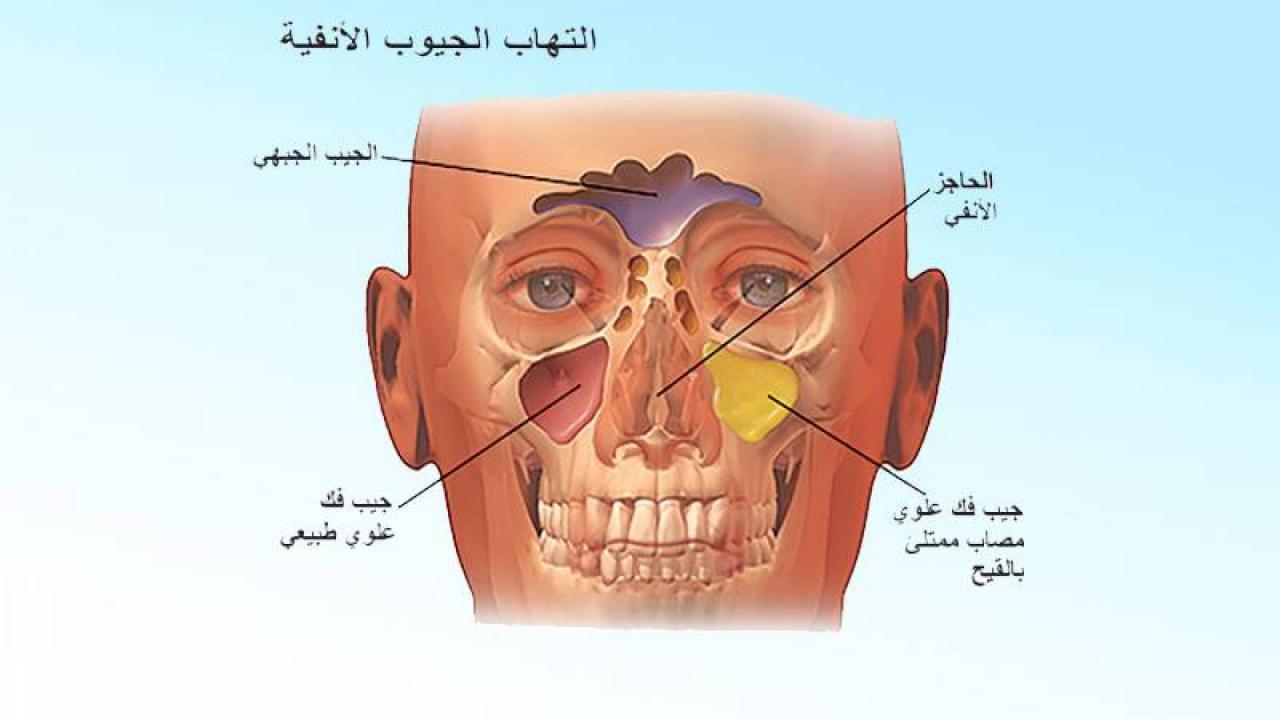 علاج للجيوب الانفية فعال باذن الله