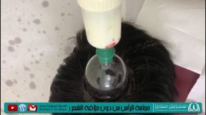 من جربت حجامة الراس بدون