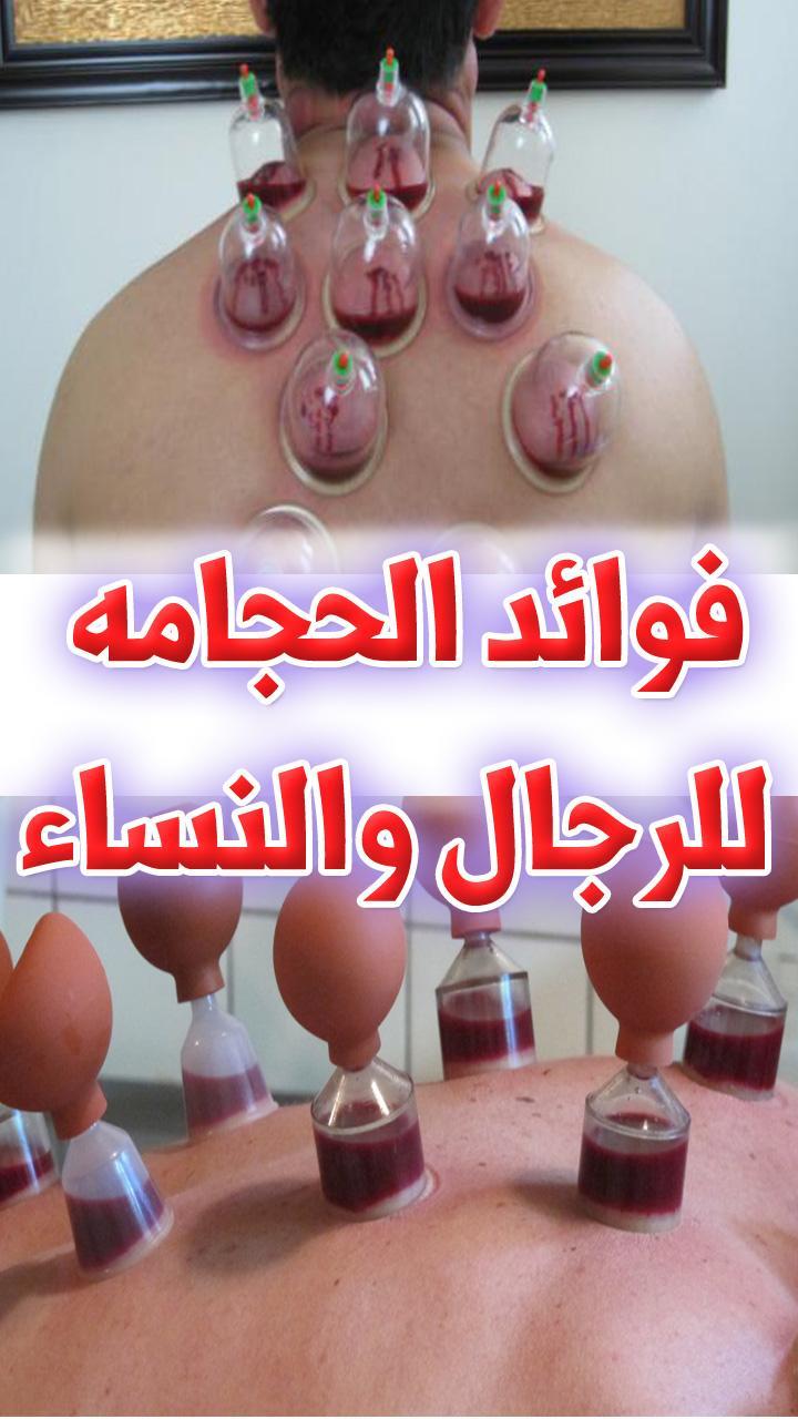 فوائد الحجامه , استخدام الحجامه