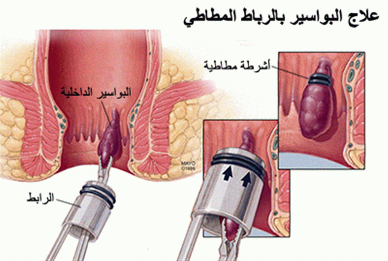 عملية البواسير بالتدبيس و الشرخ الشرجي بالكي بالكهرباء